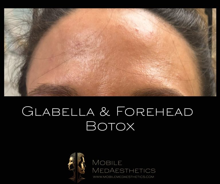 Botox for the forehead